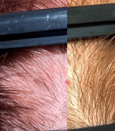 PRP for Hair Loss before and after