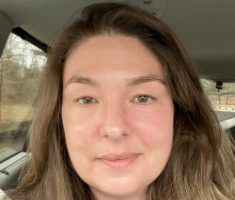 DC skincare patient shows off incredible chemical peel results