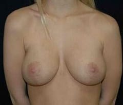 Breast reduction after