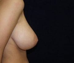 Breast reduction before