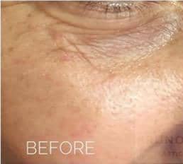 Microneedling w/ PRP Results Before
