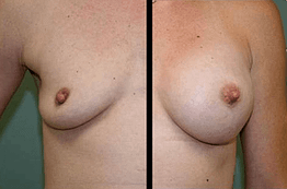 Breast Augmentation DC