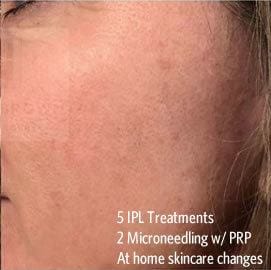 After IPL and Microneedling treatment