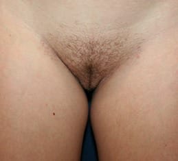 Labiaplasty Procedure DC