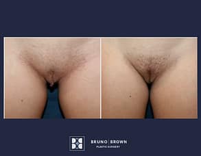 Before and After Labiaplasty