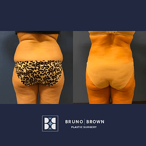 Before and after Lipo 360 in Washington DC