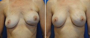 breast reconstruction, before and after