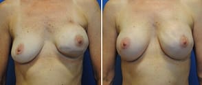 breast reconstruction, before and after