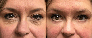 Blepharoplasty before and after in Chevy Chase, MD