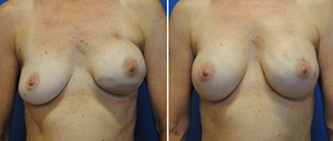 DC breast reconstruction before after