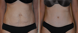 DC Tummy Tuck, before after
