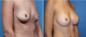 DC Breast Augmentation Specialists