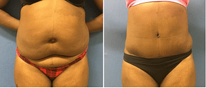 Tummy tuck procedure before and after