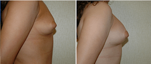 DC Fat Grafting Breast Augmentation, before and after, dc plastic surgery