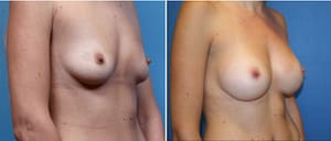 DC Breast Augmentation Specialists