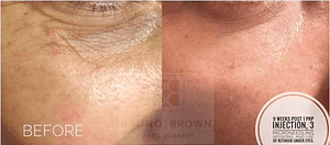 microneedling with PRP before and after Washington DC