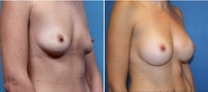 DC Breast Augmentation Specialists