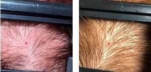 PRP Injections Hair Loss Results DC