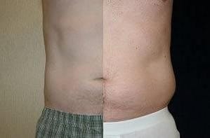 Before and after of a man that received liposuction for love handles