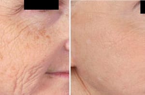 Microneedling DC Before and after