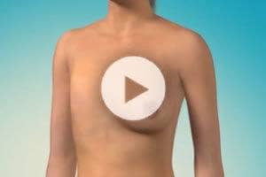 Breast Reconstruction Procedure