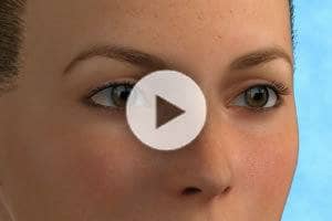 Blepharoplasty- Eyelid Surgery Info