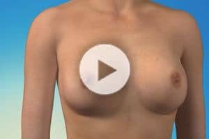 Breast Augmentation Procedure Plastic Surgery