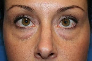 Blepharoplasty before