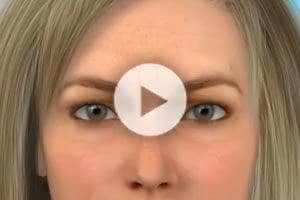 Botox Procedure Information