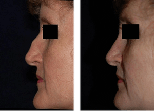 Rhinoplasty DC Nose Job Before and After