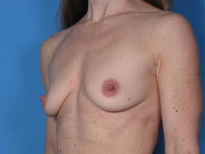 Breast augmentation before