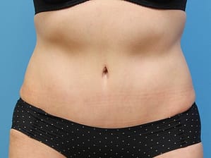 Abdominoplasty after