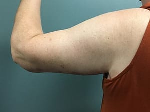 Arm Lift After (Back of Arm)
