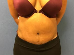 Tummy tuck front after