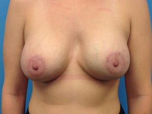 Breast augmentation front after