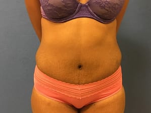 tummy tuck front after