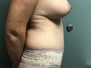 Tummy tuck after (side view)