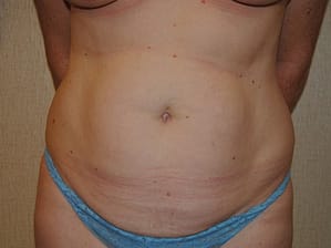 Abdominoplasty before