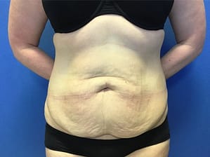 Abdominoplasty Before Front