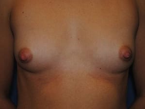 Breast augmentation front before