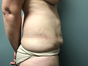 Tummy tuck before (side view)