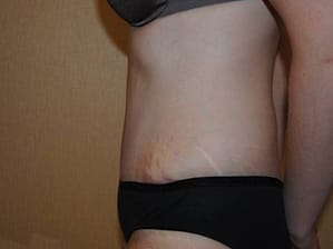 Tummy tuck side after