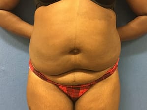 Tummy tuck front before