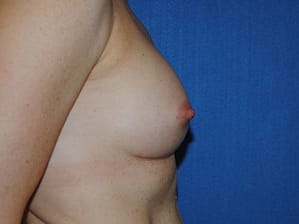 Breast augmentation side after