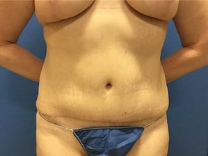 Abdominoplasty After Front