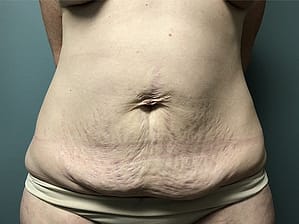 Tummy tuck before (front view)