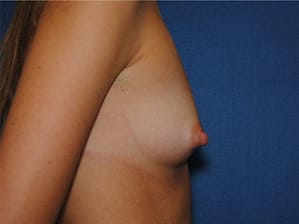 Breast augmentation side before