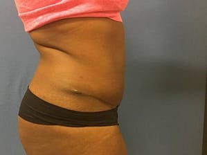 Tummy tuck side after