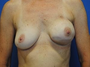 breast reconstruction DC
