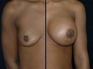Breast Implants DC
